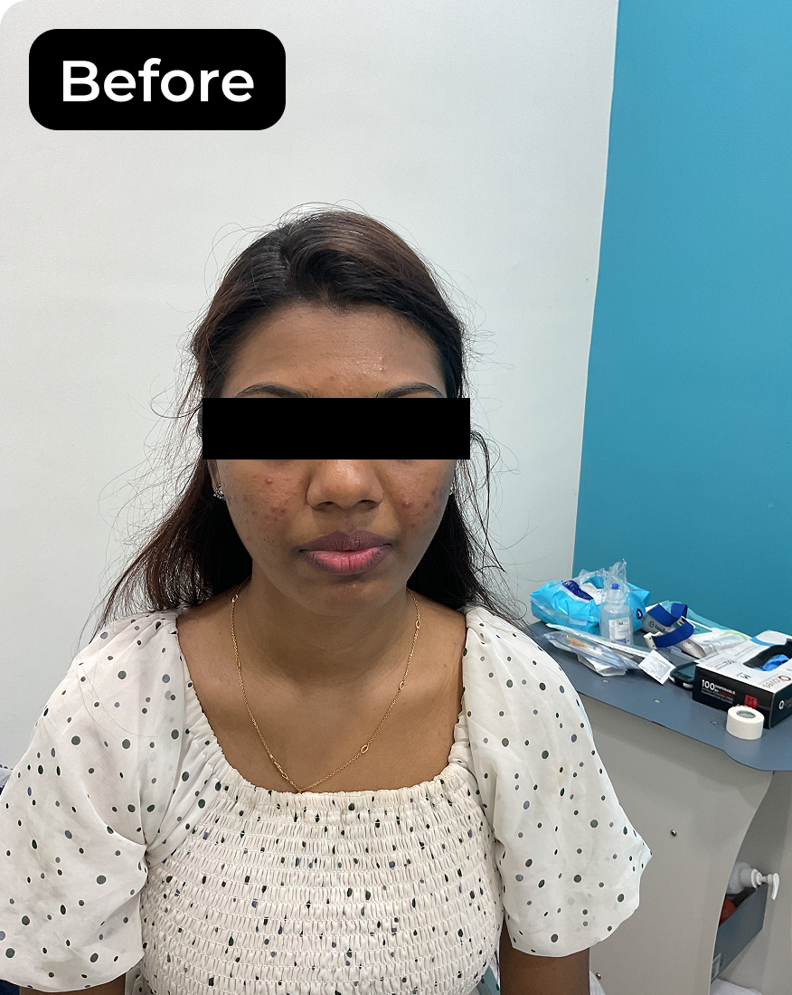 Before Acne Treatment
