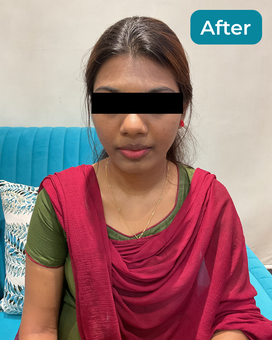 After Acne Treatment