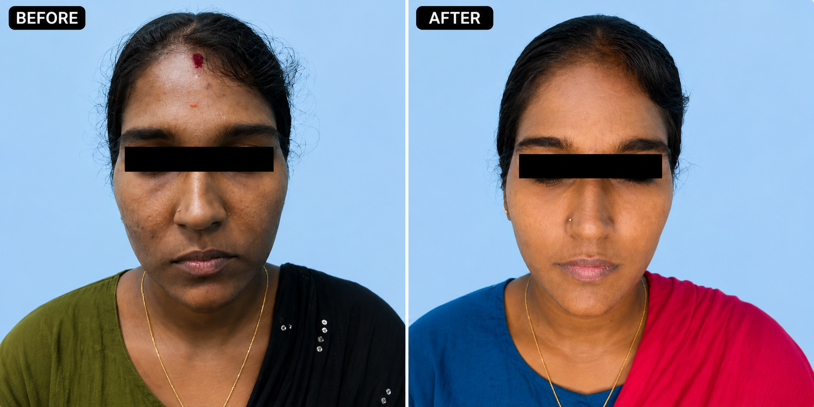 Real Results for Uneven Skin Tone: Transform Your Skin with Advanced Treatments at Amppa Skin & Hair Clinic, Mogappair West